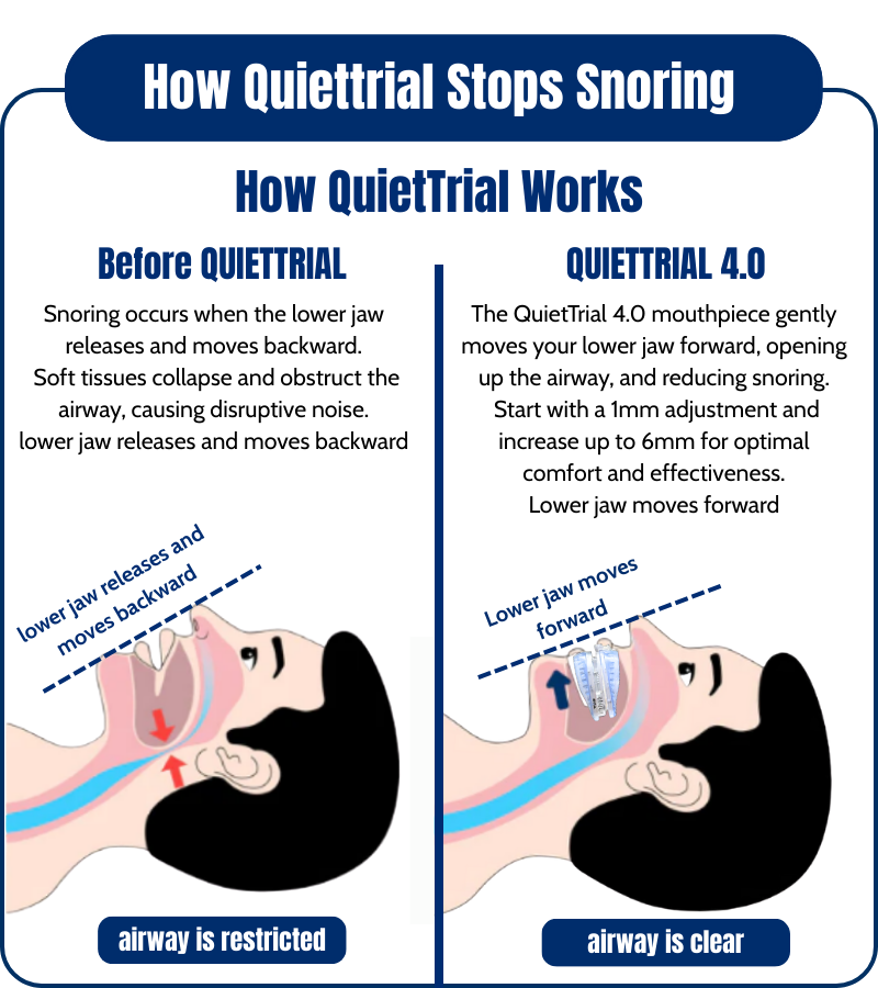 QuietTrial Plus® Anti-Snoring Mouthpiece